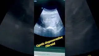 Cystic degenerative fibroid  .............................. Cystic degenerative Fibroid