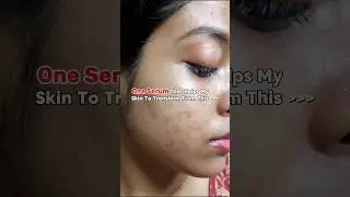 in the caption👇🏻 Best Niacinamide Serum for Dark Spots Acne marks | Serum Under 500 #acneproneskin