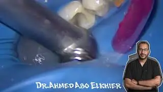 Retreatment Case of lower first Molar #الكربولة  #endodontics