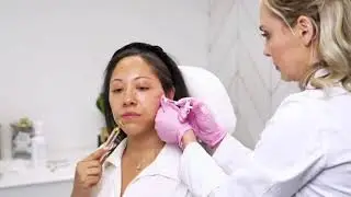 Facial Balancing with Dermal Filler