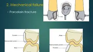 Crown and bridge Failures and Repairs