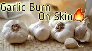 GARLIC 🧄 BURN MARK HOME REMEDY | HOW TO TREAT GARLIC BURN SCAR