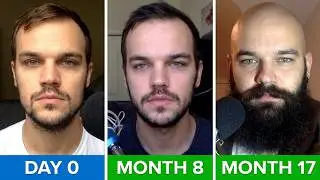 Minoxidil Journey - A Comprehensive Overview