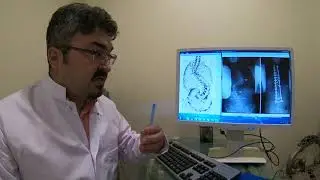 Do adult patients with scoliosis need surgery?