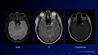 Neuroradiology Board Review - Brain Tumors - Case 8