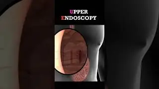 Upper Endoscopy Procedure #shorts #endoscopy