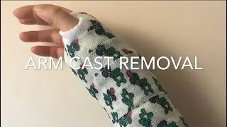 Arm cast removal | Rad Rachael