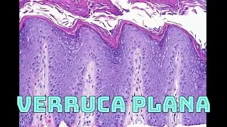 Verruca plana (flat wart) under microscope histology pathology dermatology