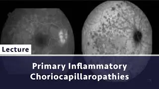 Primary Inflammatory Choriocapillaropathies  Insights From Multimodal Imaging