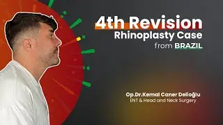 Revision Rhinoplasty Patient Story: From 3 Failed Surgeries to a Masculine Nose