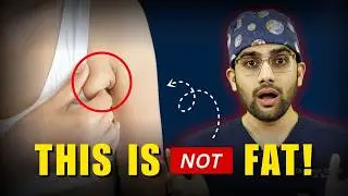 Arm-Pit Fat या Axillary Breast Tissue &ndash; फर्क समझिए for Permanent Reduction | Dr.DC | India, Pune