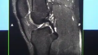 Knee MRI Part 1 Normal Anatomy for Orthopaedic and Radiology Residents