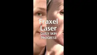 Fraxel Laser Journey - Skin after treatment, downtime and skin texture