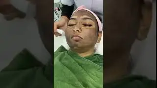 My Skin Journey | After BB5 | Pico Laser Treatment | Dr. Esha | Nadia Chang