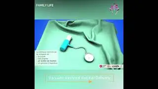 Vacuum and forceps-assisted # birth