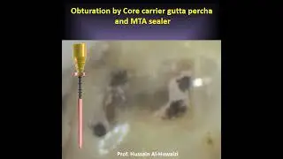 Retreatment of a tooth with missed canal and periapical lesion.