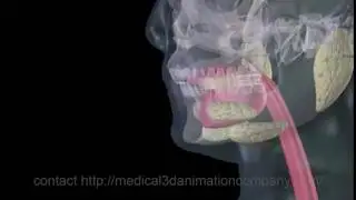gastric bypass surgery bariatric 3d medical animation company studio 3d visualization healthcare san