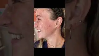 See the INCREDIBLE Results After Just One Lumecca IPL Treatment | #beauty #skincare #shorts