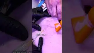 Tratamento de varizes que mais realizamos
