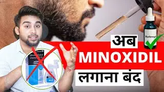 Redensyl Vs. Minoxidil Kiske Acche Results Hai 🔥🔥🔥