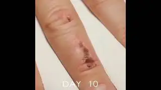 WOUND HEALING TIMELAPSE⚕️&hearts;️