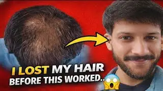 Hairloss Reality No one talks about ( No fake promises) Shivankur Sharma 