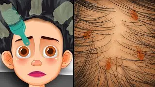 ASMR Parasite Removal Animation | Lice & Scalp Dermatitis Deep Clean