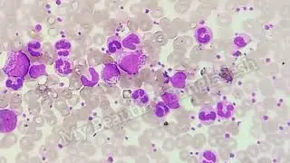 Chronic myeloid leukaemia Chronic phase. Chronic phase Chronic myeloid leukaemia (CML).
