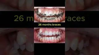 Braces journey. 26 months to complete #braces #dentist #orthodontist #teeth