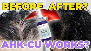 AHK-CU for Hair Growth | Evidence + Protocol (vs GHK-CU)