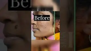 #FRESHLOOK PEEL #DrAyeshaFaizan #pigmentation #acne #oochronosis #loveyourskin