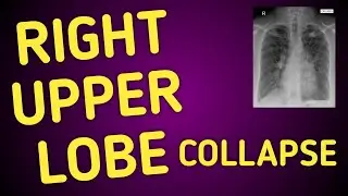 Describing RUL Collapse on chest xray! GOLDEN 'S' SIGN