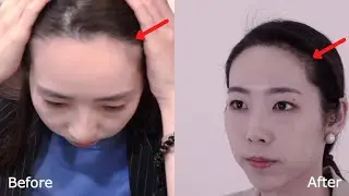 Hair Transplant in Korea - 4 Month Update | Seoul Guide Medical