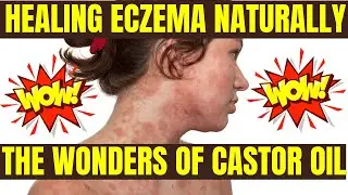 HEALING ECZEMA NATURALLY THE WONDERS OF CASTOR OIL