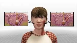 Breakthrough leads to discovery finding cause of port wine birthmarks