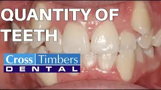 Quantity of teeth: The Cosmetic Quadrant