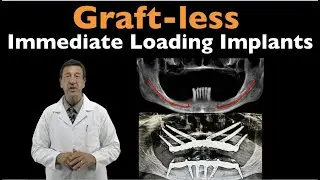 Are You looking for Graft less immediate Loading solution? Quickdent Dental Implants