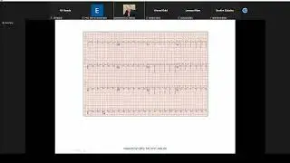 Atypical AVNRT   Dr  Ahmed Nabil