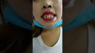 Tooth removal with implant / Getting Dental Filling / dental tutorial