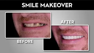 Smile Makeover Before and After Pictures | Best Dentist in Pakistan | Dental Aesthetics Lahore