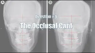 Question 8: The Occlusal Cant