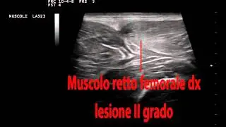 Muscolo retto femorale lesione di secondo grado