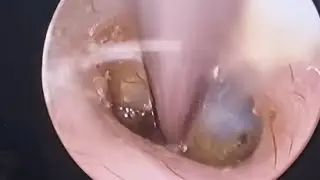 Healthy ear care routine,easy ear cleaning advice,ear cleaning safety tips,Dr sudhir sultan