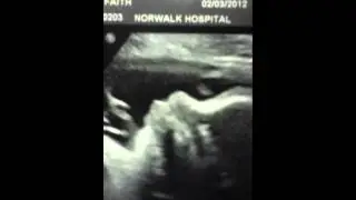 32 Weeks Pregnant Ultrasound Compilation