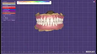 Upper & lower full mouth designing in Exocad for durable prosthesis