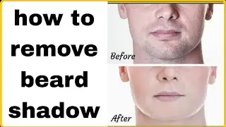 how to remove beard shadow | beard shadow remove home treatment !