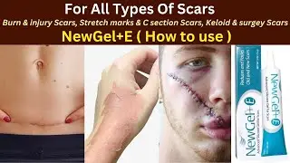 Newgel+e: как использовать | Newgel от акне, ожогов, келоидных рубцов и шрамов после операций | Л...