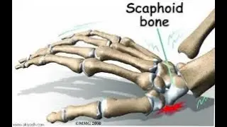 Grade 1 Lunate Bone Bruise:  Treatment#LunateBone#LunateBoneBruise#WristInjury#tiktok 