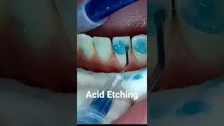 Acid etching before placing braces. #braces #orthodontics #bracesadjustment #shorts