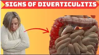 Understanding the SUBTLE Indicators of DIVERTICULITIS